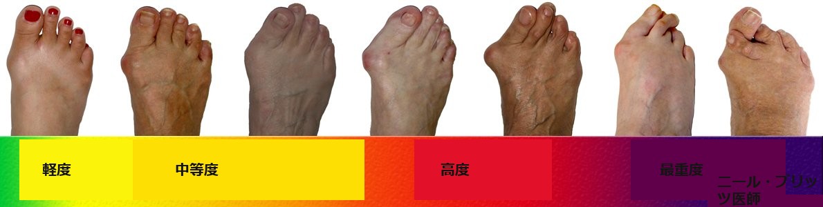 外反母趾の進み方の段階(軽度から重度)