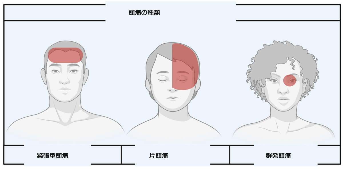 緊張型・片頭痛・群発頭痛の痛む場所の図