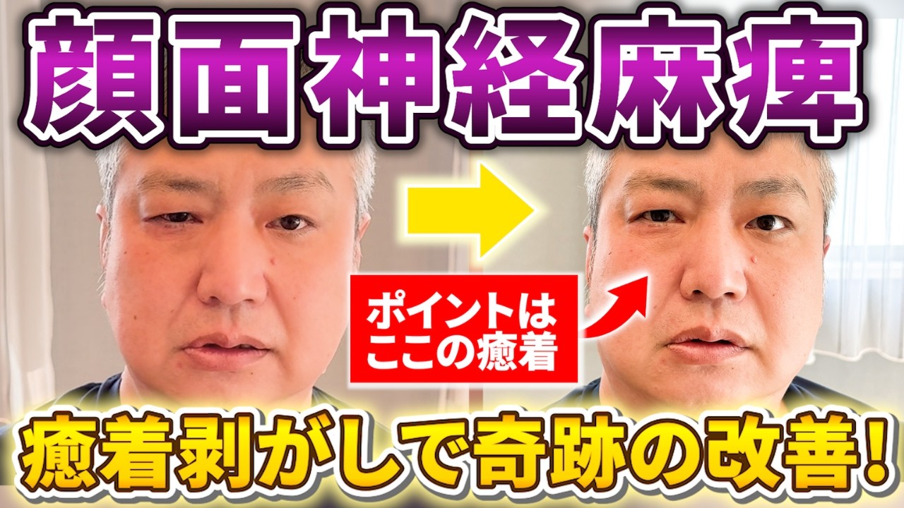 顔面神経麻痺の症例動画サムネイル