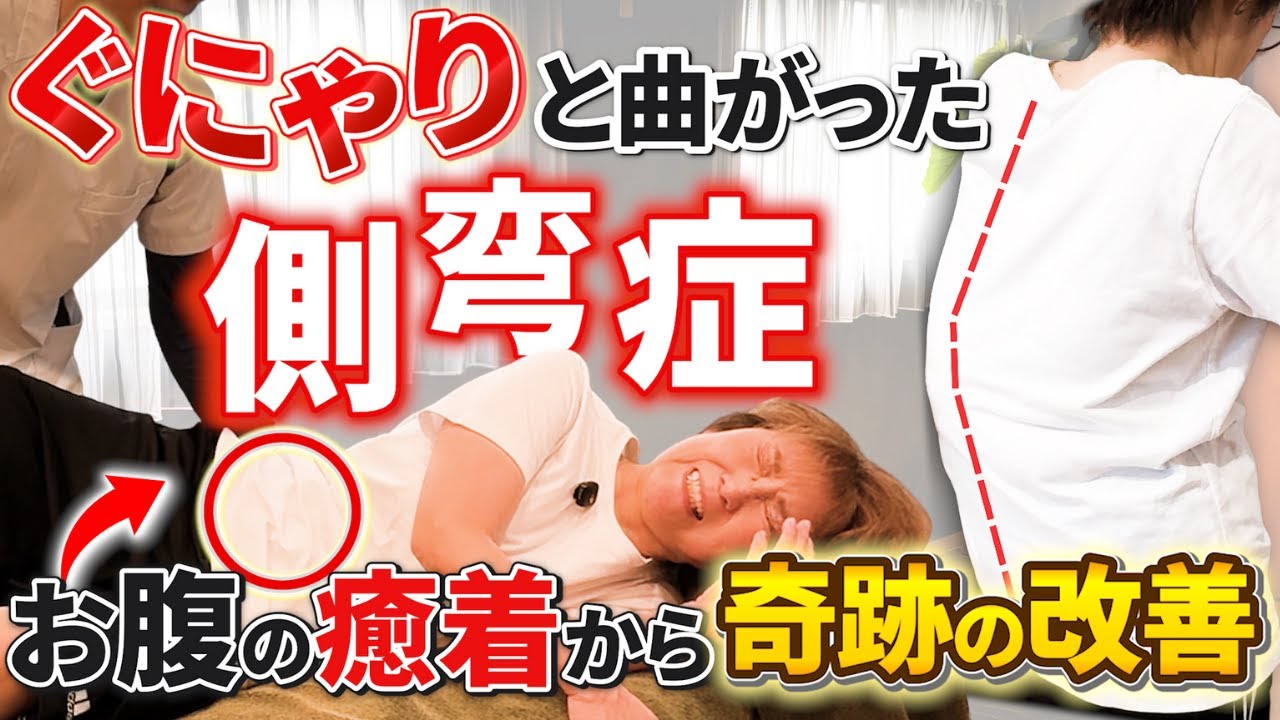 側弯症・腰痛の症例動画サムネイル