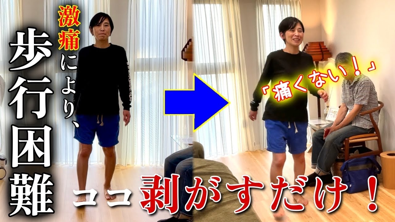 変形性股関節症の症例動画サムネイル