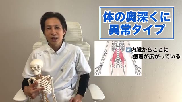 ②体の奥深く（内臓の近く）から癒着が広がるタイプ（動画より）